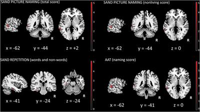 Neuroanatomical correlates of screening for aphasia in NeuroDegeneration (SAND) battery in non-fluent/agrammatic variant of primary progressive aphasia